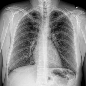 Снимок флюорографии легких